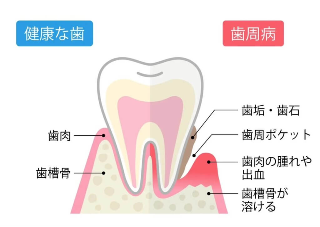🦷成人の8割が罹患しているお口の病気🦷