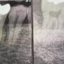 【自費の根管治療で抜歯を回避した症例】